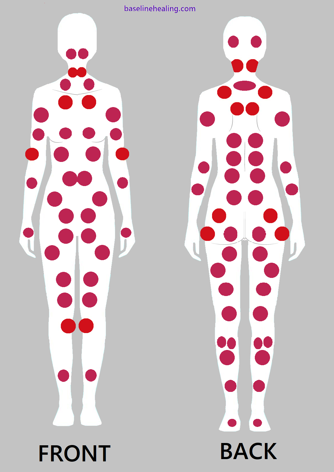 The same two images from above but with more tender points added. Front and back, the body is covered in dots symbolising areas of muscle pain. The myalgia of imbalance causes body-wide stress, cumulative and spreading.